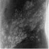 Shingles