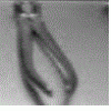 Extraction device